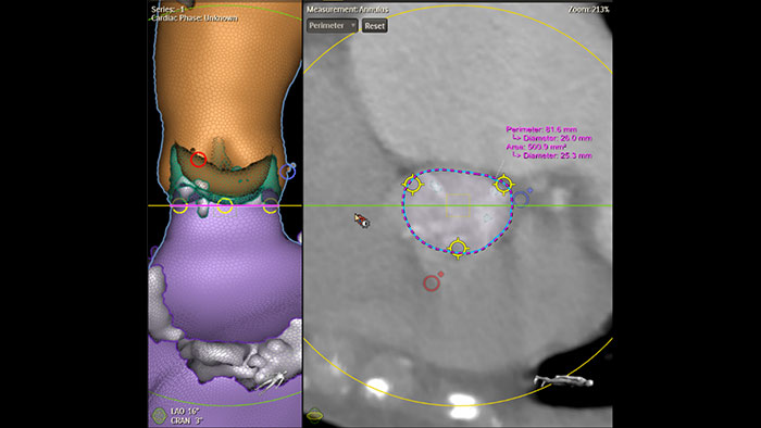 Imagem cl&iacute;nica do HeartNavigator da Philips