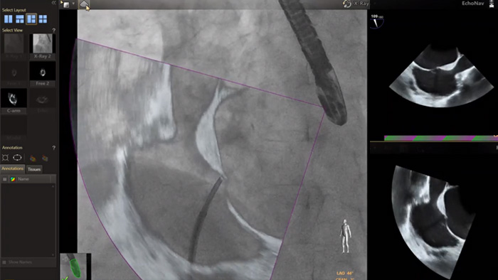 Modelos de v&aacute;lvula mitral e a&oacute;rtica do EchoNav