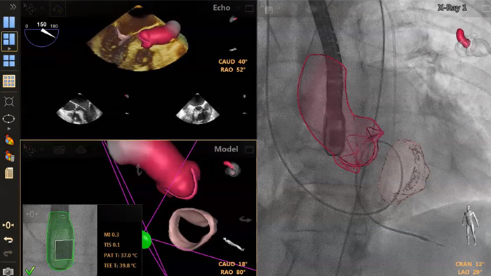 Orienta&ccedil;&atilde;o de pun&ccedil;&atilde;o transeptal